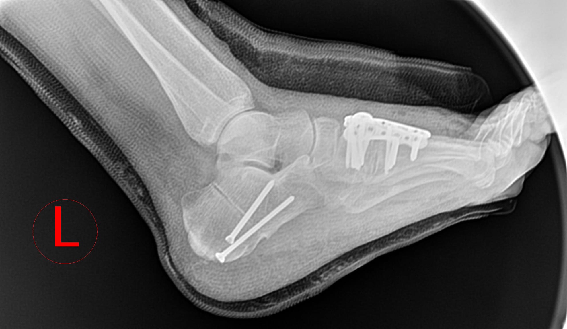AllFit™ VA Plate System