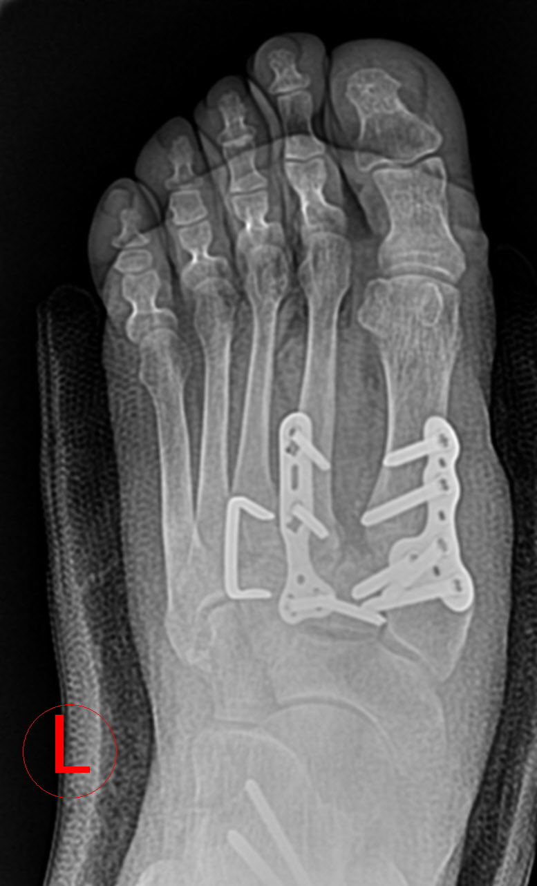 AllFit™ VA Plate System view 2