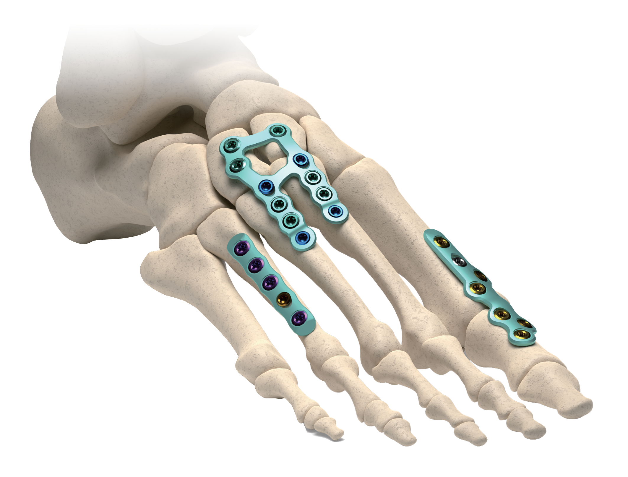 AllFit™ VA Plate System view 4