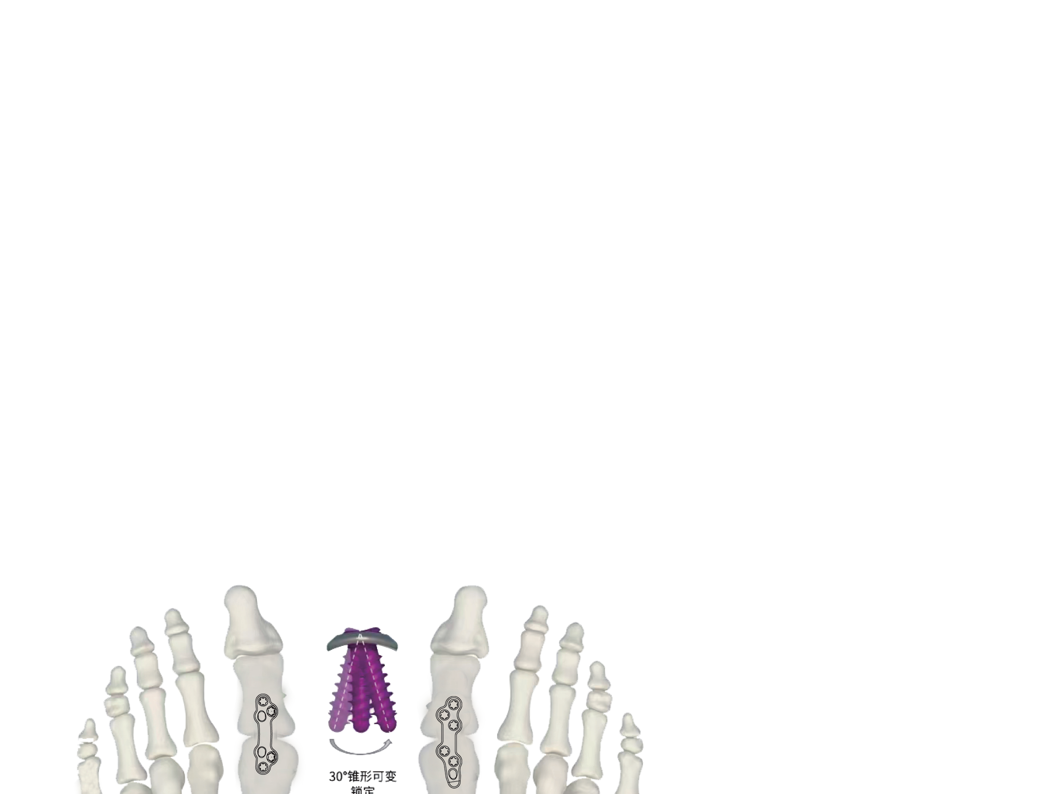 AllFit™ VA Plate System view 5
