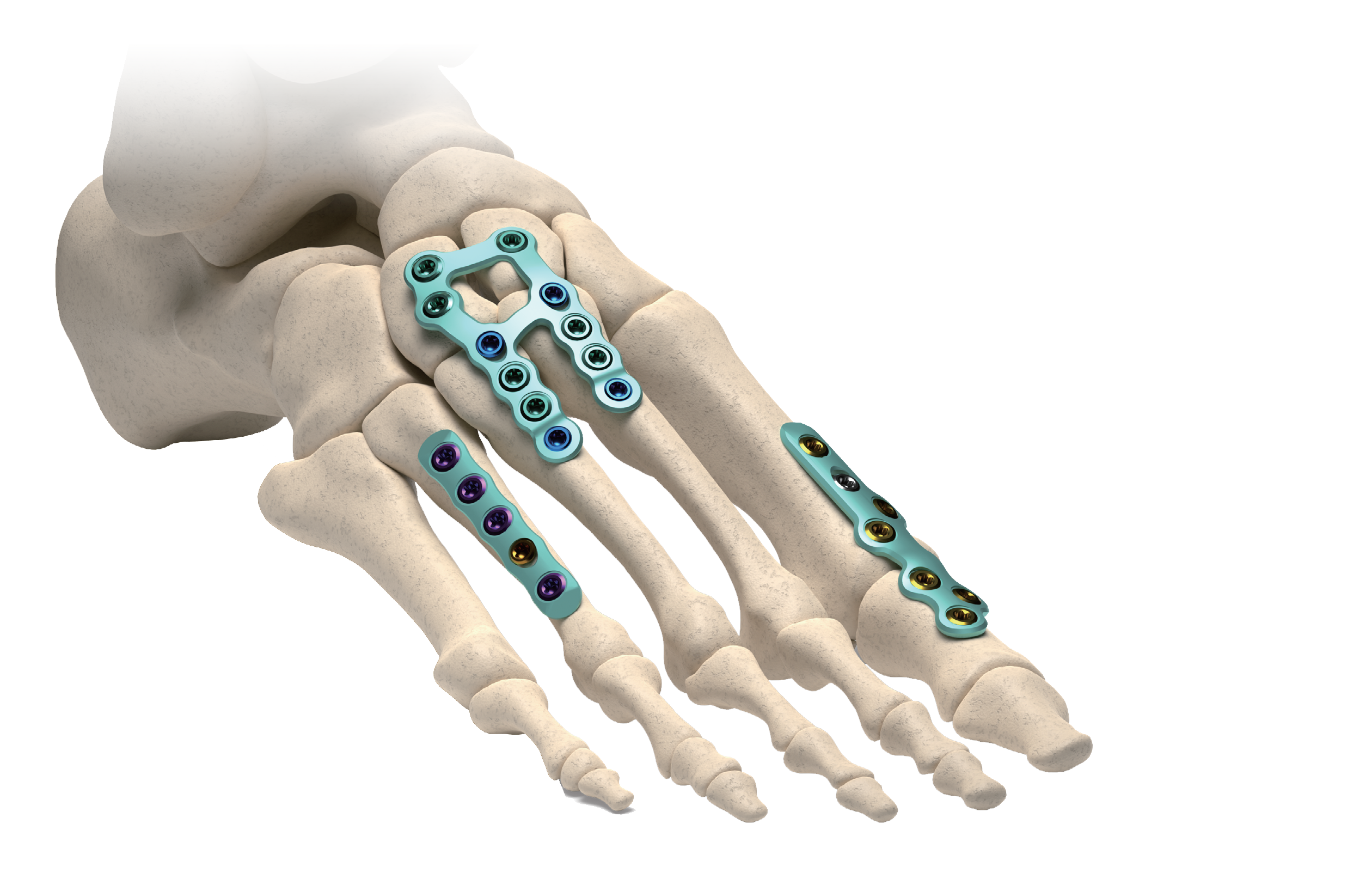 AllFit™ VA Plate System view 6