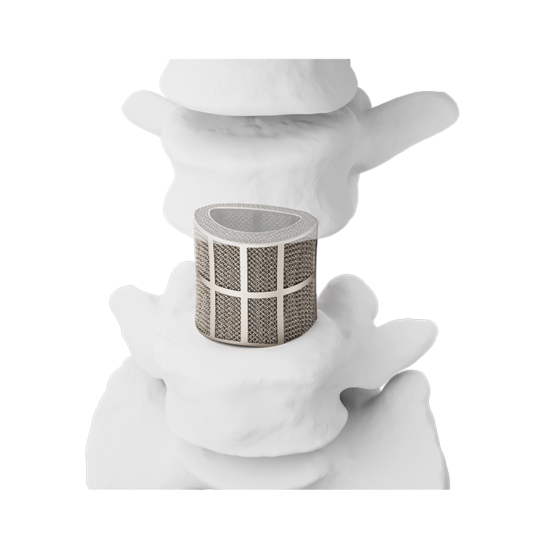 3D printed titanium spinal interbody fusion cage