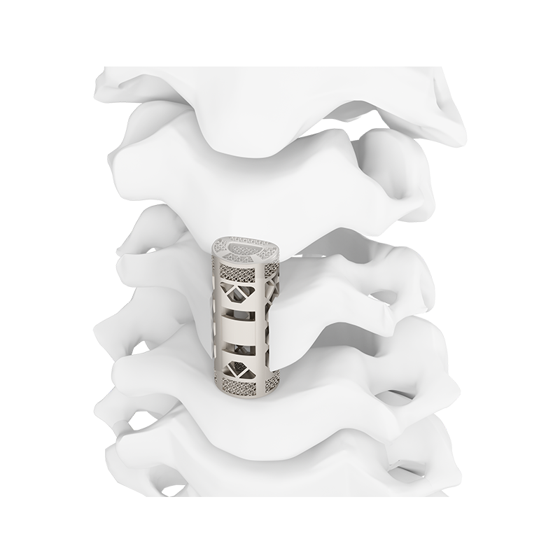 3D Printed Porous Cervical Artificial Vertebral Body Type II