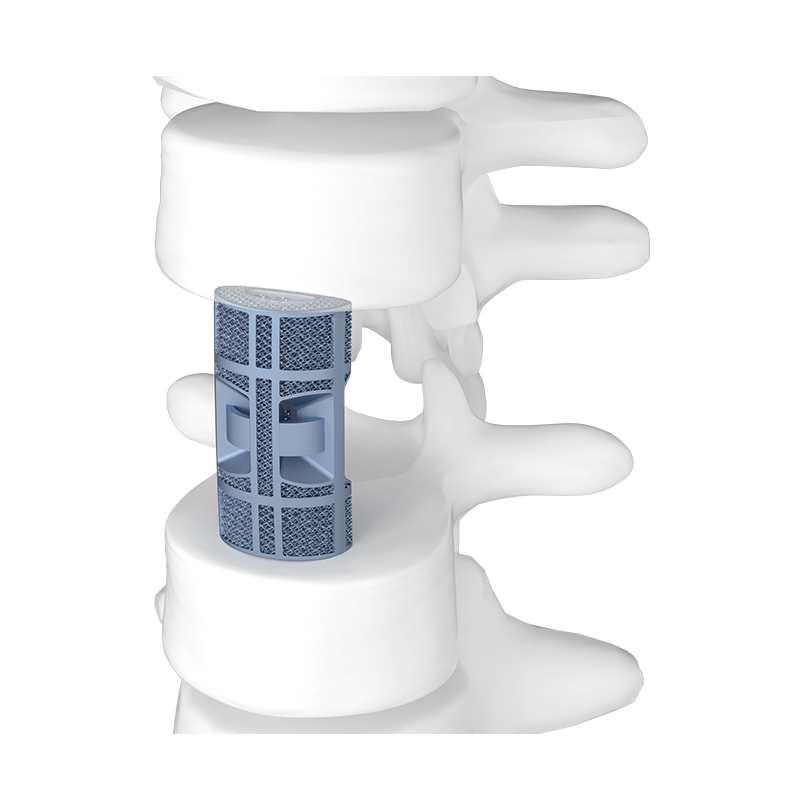3D Printed Porous Thoracolumbar Artificial Vertebral Body Type IV