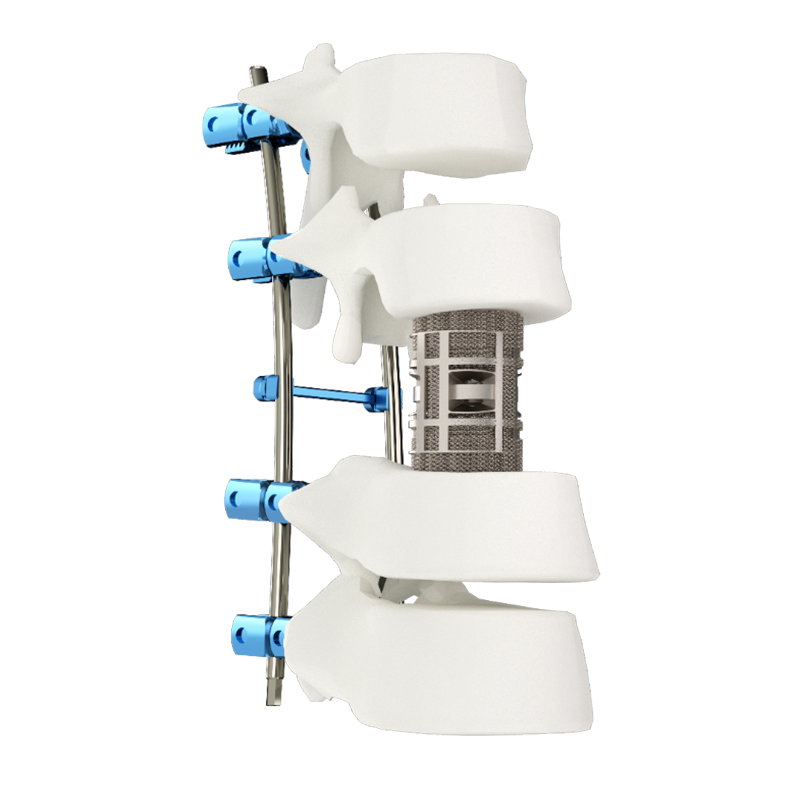 3D Printed Porous Thoracolumbar Artificial Vertebral Body