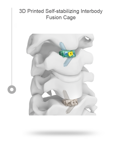 3D Printed Self-Stabilizing Cervical Interbody Fusion Cage