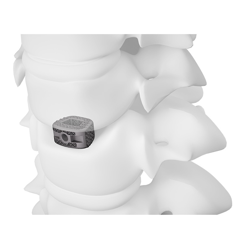 3D Printed Surface Modified Cervical Interbody Fusion Cage Type I