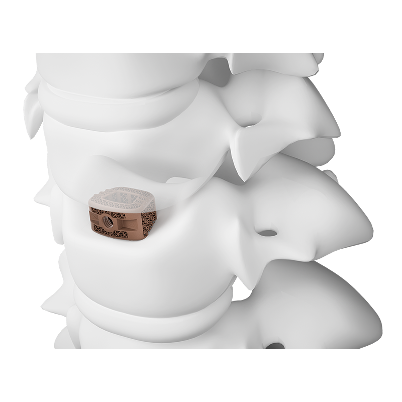 3D Printed Surface Modified Cervical Interbody Fusion Cage Type II