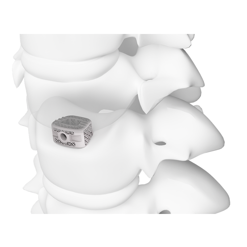 3D Printed Surface Modified Cervical Interbody Fusion Cage Type III