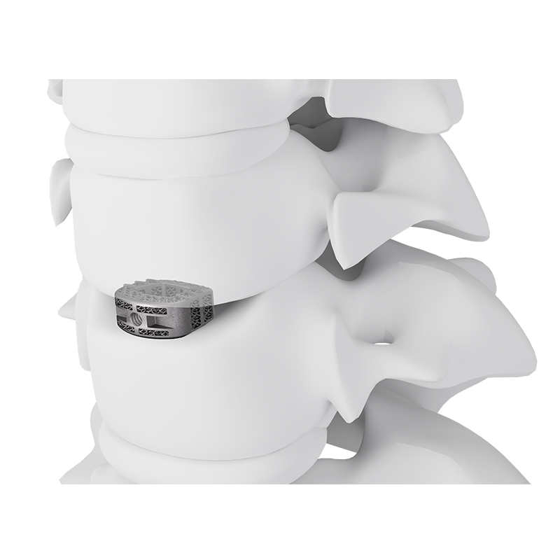 3D Printed Tantalum Metal Cervical Interbody Fusion Cage